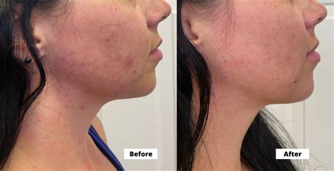 Acne Cosmetic Acupuncture Before And After Photos Seneca Falls