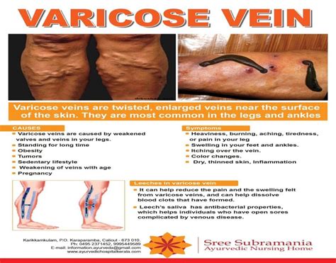 Treatments For Varicose Veins Sree Subramania Hospital
