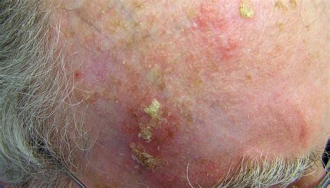 Actinic Keratosis Solar Keratosis Contour Dermatology