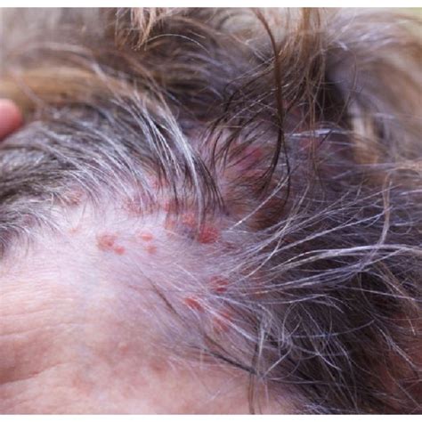 Lateral View Of Scalp Demonstrating Heterogeneity Of Texture Among