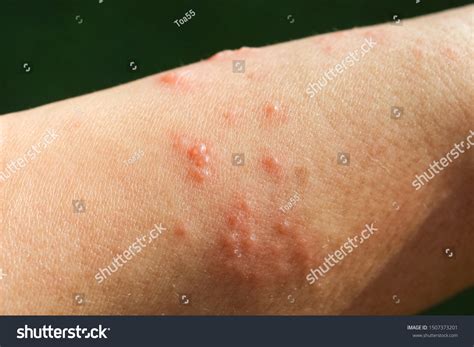 Skin Rash Allergic Symptoms Due Arm Stock Photo 1507373201 Shutterstock