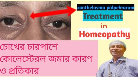 চোখের পাতার কোলেস্টেরল কমানোর উপায়।xanthelasma Homeopathy Treatment