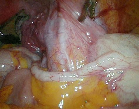 Image of something do for example, in one of my assignments i had to put a questionnaire i did not design in the appendix. File:Vermiform appendix.jpg - Wikimedia Commons