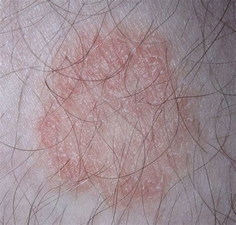 Fungal Skin Infection What Causes Fungal Skin Infections Lsah Clinic