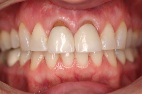 Gingival Sculpting Bucks County Dental Design