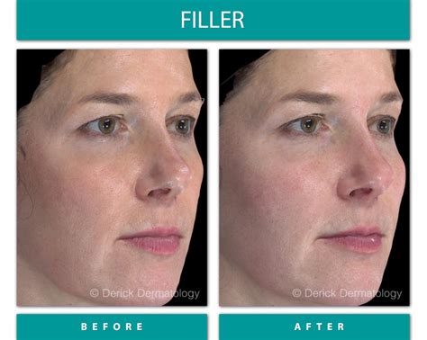 Before And After Gallery Filler Derick Dermatology