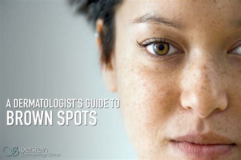 Everything You Need To Know About Brown Spots