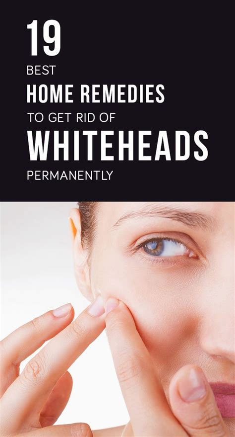 How To Get Rid Of Whiteheads Naturally At Home Artofit