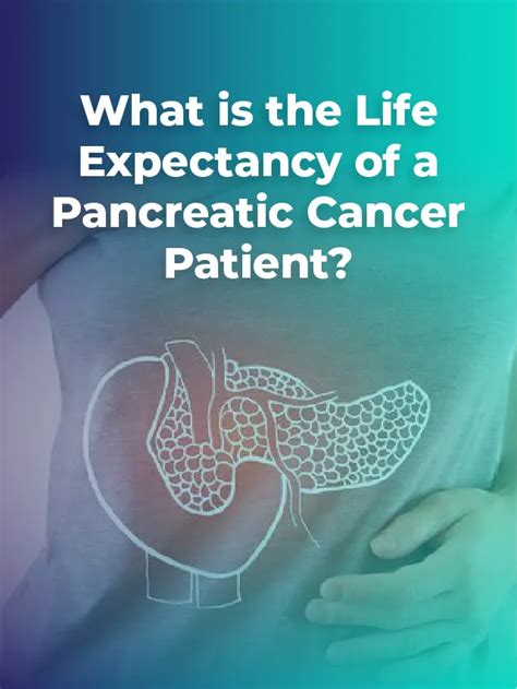 What Is The Life Expectancy Of A Pancreatic Cancer Patient Dr