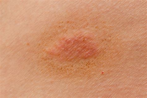Ringworm On The Skin Of A Person The Alternative Daily
