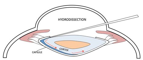 Moran Core Hydrodissection And Hydrodelineation