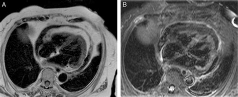 A Cardiovascular Magnetic Resonance Imaging T2 Turbo Spin Echo