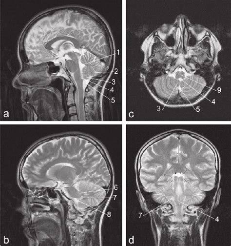 Magnetic Resonance Imaging Of The Head T2 Presentation Sagittal A