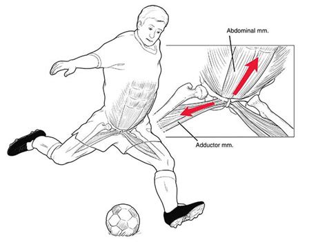 Pubalgia Causes And Treatment Soccer Coaching