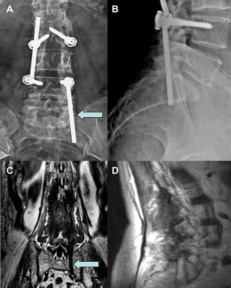 Ap And Ll Lumbar X Ray Performed After An S1 Left Radiculopathy Onset