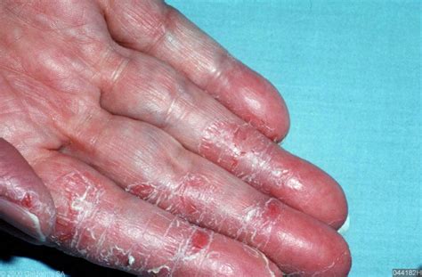 Irritant Hand Dermatitis Stamford Skin Centre