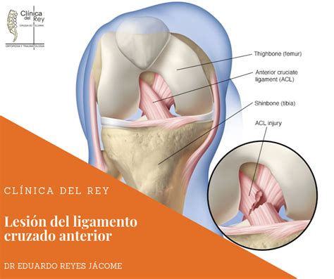lesión del ligamento cruzado anterior cirugia de columna en matamoros