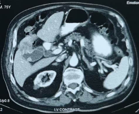 Ct Scan Image Of The Abdomen Revealing A Distended Gallbladder Filled