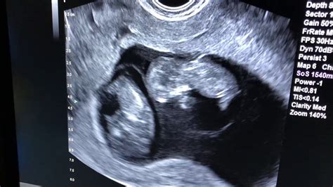Identical Twins Ultrasound 10 Weeks