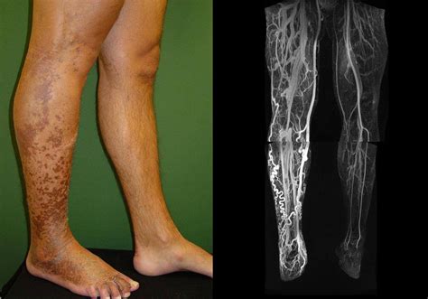 Diagnosis And Management Of Extensive Vascular Malformations Of The