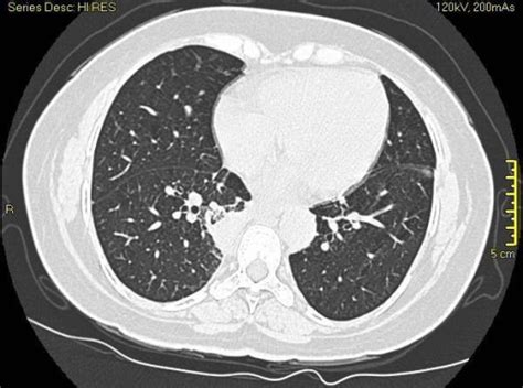 High Resolution Ct Scan Of The Chest Showing The Lung N