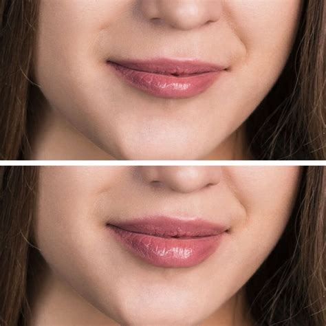 Why Dermal Fillers Are The Best Method For Lip Augmentation Ny Metro