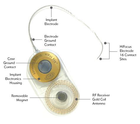 Cochlear Implant Parts Diagram Wiring Diagram Pictures