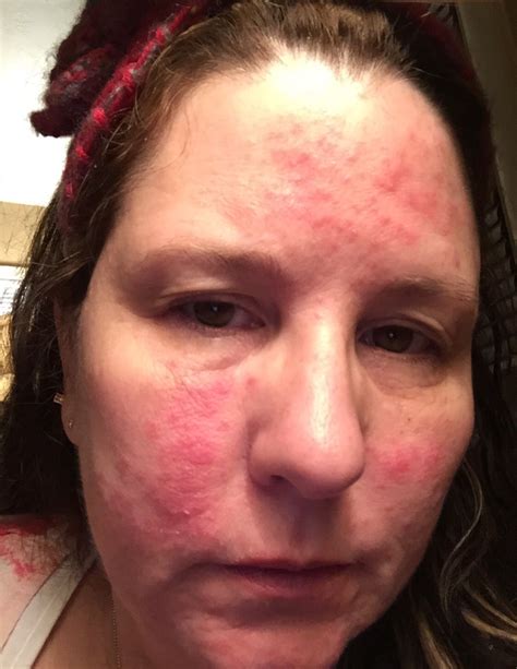 Lupus Butterfly Rash Or Is This Rosacea Lupus Rash Lupus