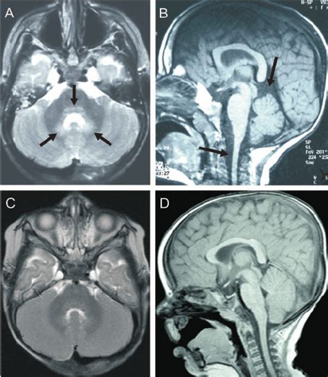 Brain Mri Findings A The T2 Weighted Axial Image Of Patient 1 At