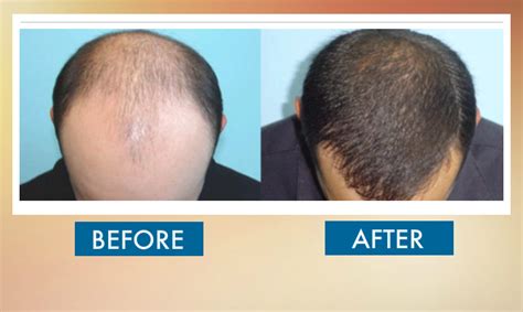 Hair Transplant Sydney 6900gst For 1500 Grafts Fue Dr Daood