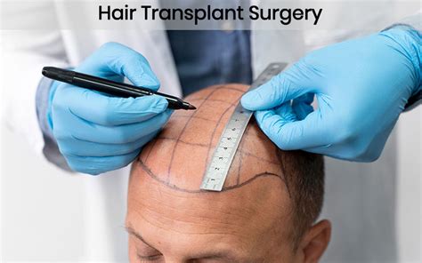 Hair Transplant Types Procedure Recovery Complications Flood