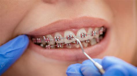How Much Do Braces Cost In Uk Angel Orthodontics