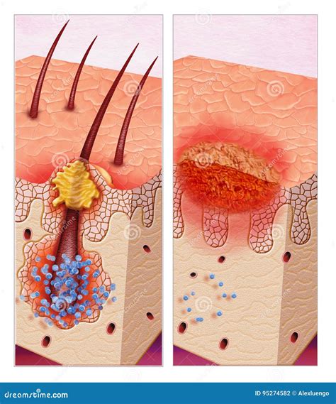 Pustula Or Folliculitis Stock Illustration Illustration Of