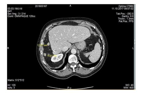Peritoneal Carcinomatosis Of Hepatocellular Carcinoma After Resection