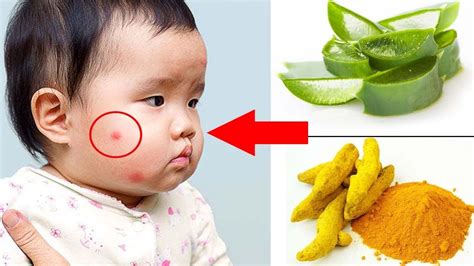 9 Natural Remedies To Cure Mosquito Bites In Babies Youtube