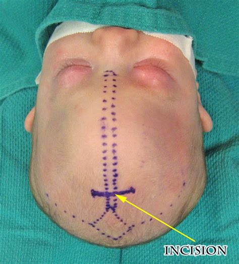 Metopic Synostosis Facts And Photos Craniosynostosis