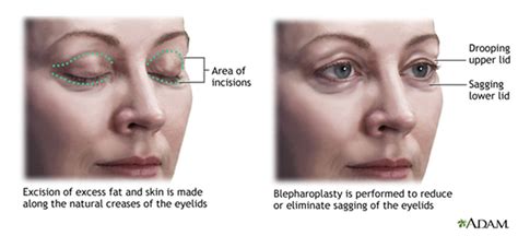 What Are The Steps Of An Eyelid Surgery Procedure Eye