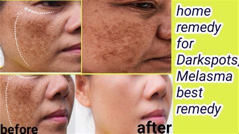 How To Remove Melasma Pigmentation Darkspots And Brownspots Results