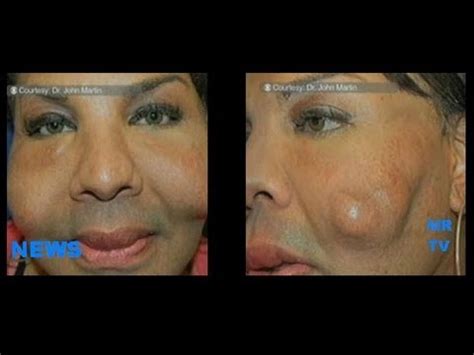 Fake Doctor Injecting Cement Fix A Flat Superglue In Patient Face Wtf