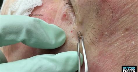 Dr Pimple Popper Just Released Her Own Blackhead Tweezers — And Heres How They Work