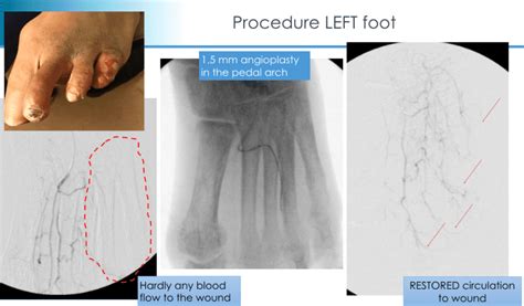 Dr Rundback Limb Salvage Procedure Case Ae
