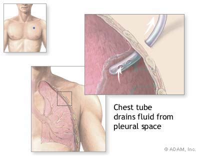July 7, 2016july 12, 2019 staff 0 comments. chest tubes - meddic