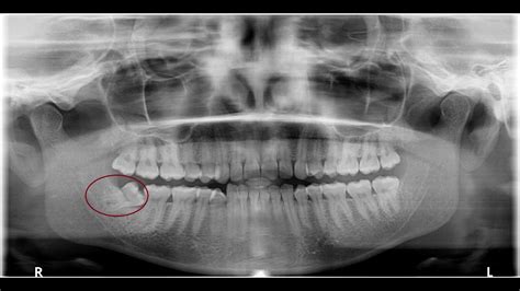Horizontally Impacted Wisdom Tooth Removal Surgical Video Youtube