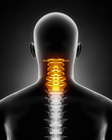 Neck Disc Injury Slipped Neck Disc Slipped The Disc In Your Neck
