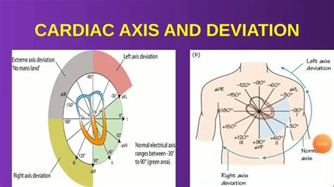Cardiac Axis And Axis Deviation Explained With Ecg Findings Youtube