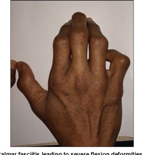 Figure 2 From Paraneoplastic Palmar Fasciitis And Polyarthritis