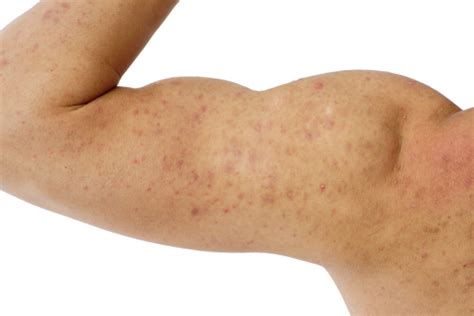 Acne On A Males Arm And Shoulder Stock Photo Download Image Now Istock