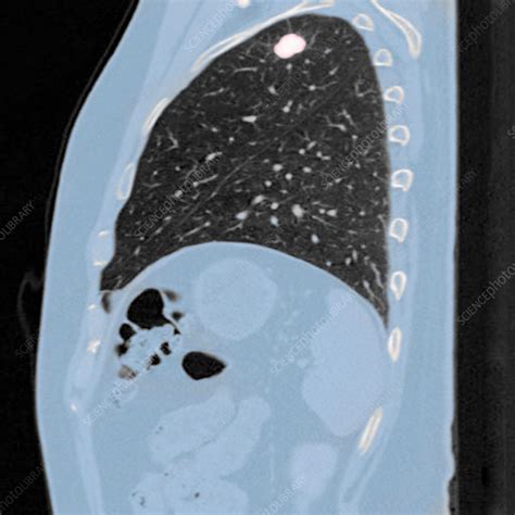 Early Lung Cancer Ct Scan