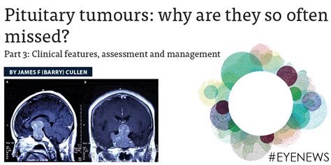 pituitary tumours why are they so often missed eye news medium