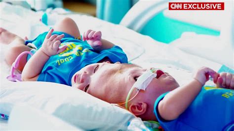 Formerly Conjoined Twins Now In Recovery Cnn Video